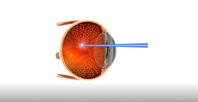 Fotocoagulação de retina a laser